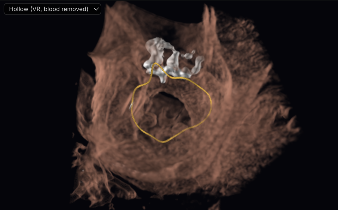 QuanMitral · left atrial view of the annulus and calcium