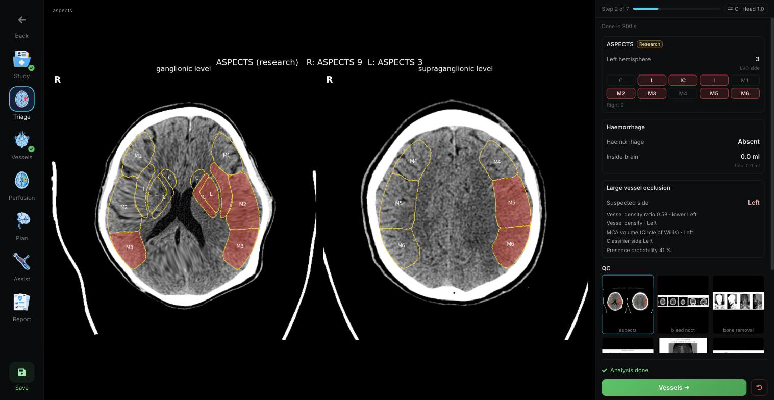 QuanSTROKE · ASPECTS and stroke triage findings