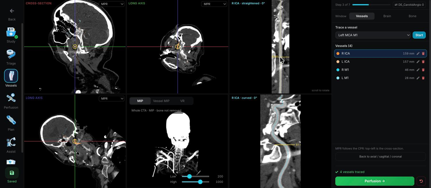 QuanSTROKE · CTA vessel review and tracing